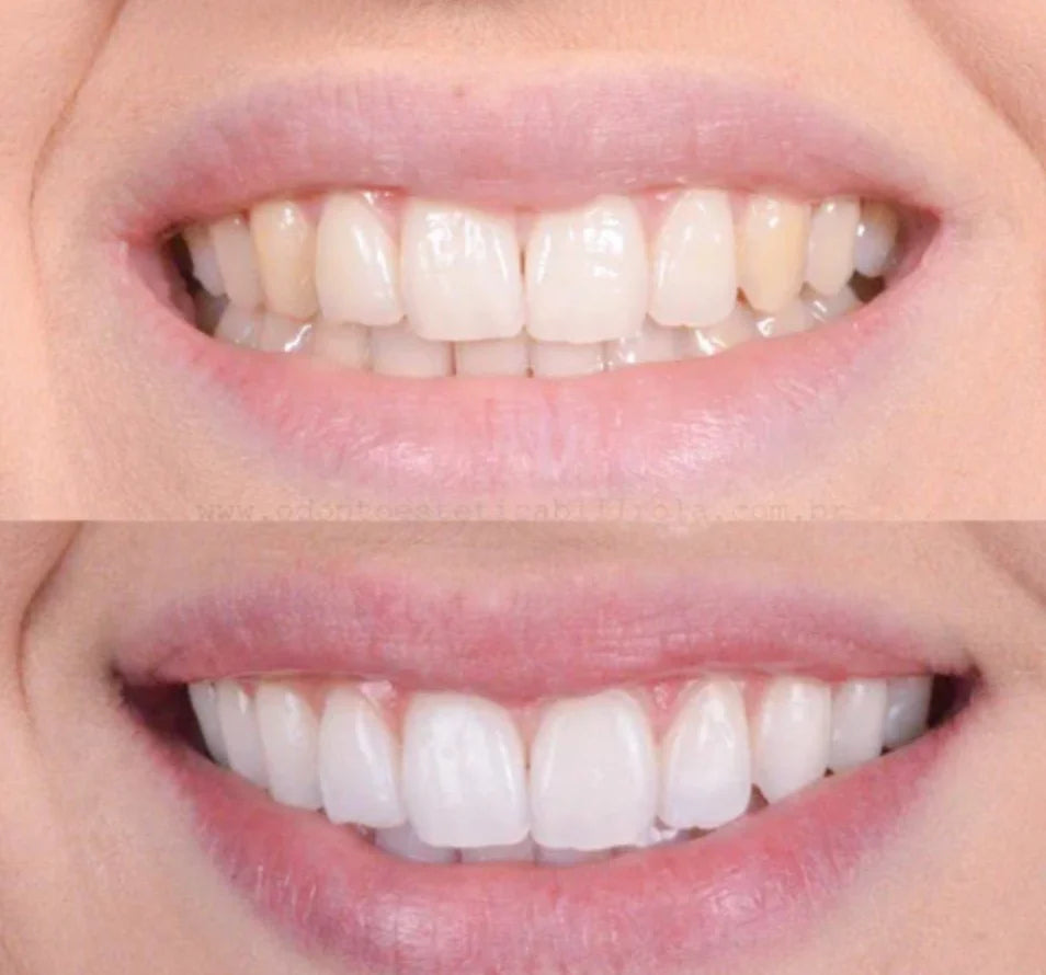 DentoBright™ Tandblegningspen - Hvidere tænder med en klinisk inspireret formel