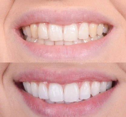 DentoBright™ Tandblegningspen - Hvidere tænder med en klinisk inspireret formel