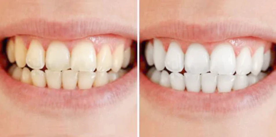 DentoBright™ Tandblegningspen - Hvidere tænder med en klinisk inspireret formel