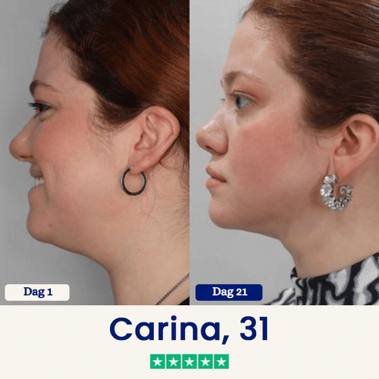 ChinLift™ - Fjern din dobbelthage på 3 uger