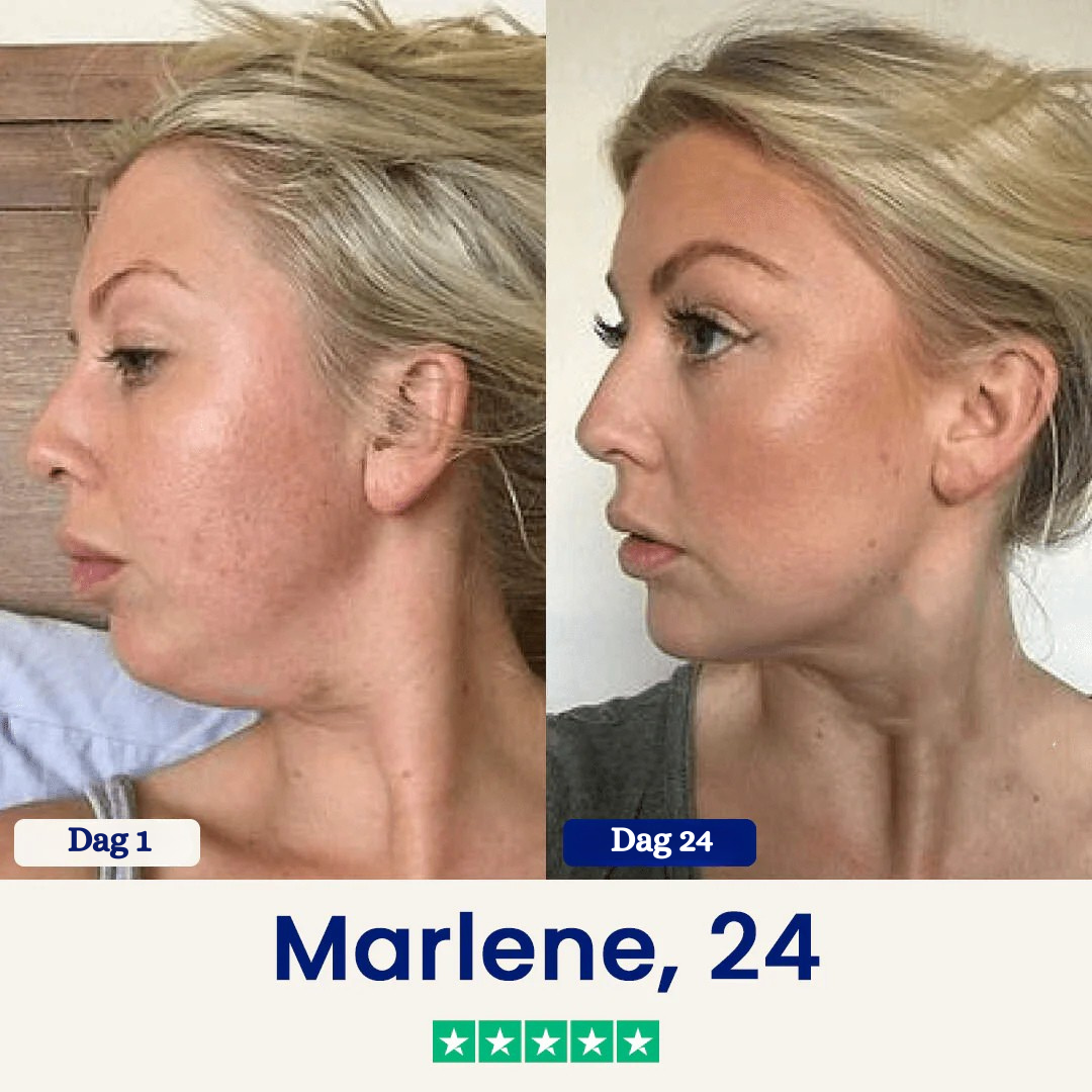 ChinLift™ - Fjern din dobbelthage på 3 uger