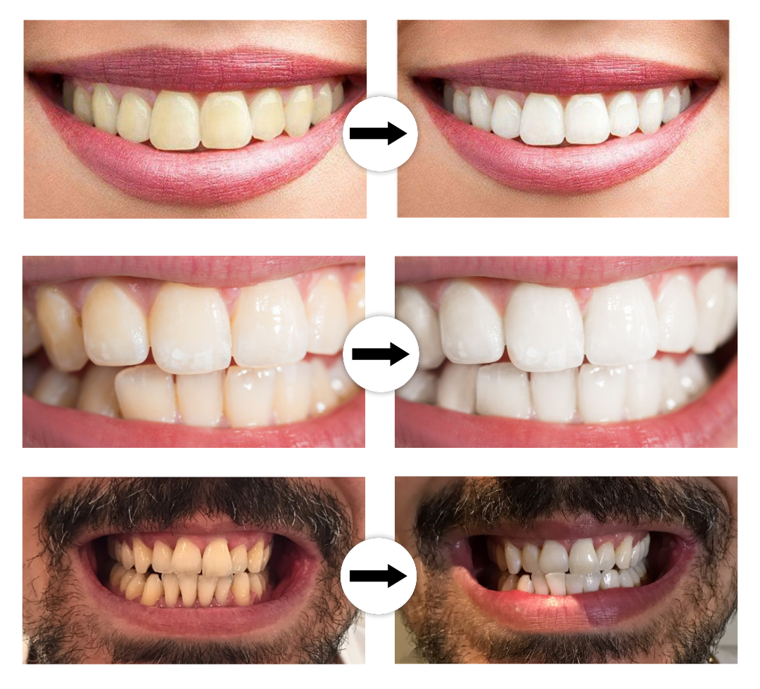 DentoBright™ Tandblegningspen - Hvidere tænder med en klinisk inspireret formel