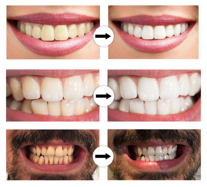 DentoBright™ Tandblegningspen - Hvidere tænder med en klinisk inspireret formel