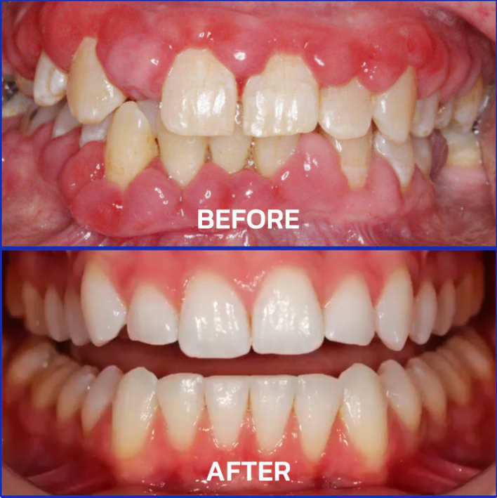 Parodentix™ - Fjerner plak og styrker tandkød naturligt