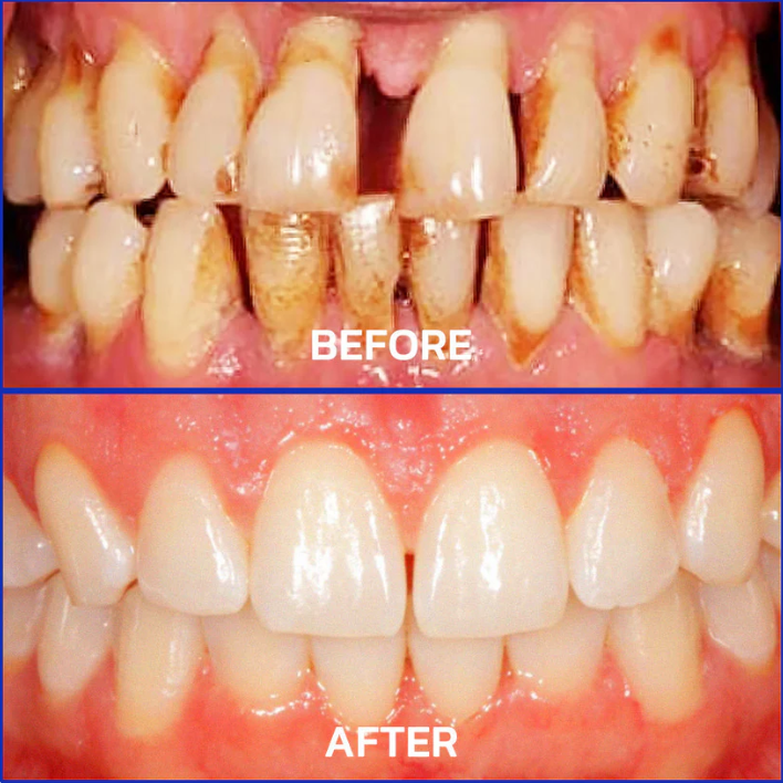 Parodentix™ - Fjerner plak og styrker tandkød naturligt