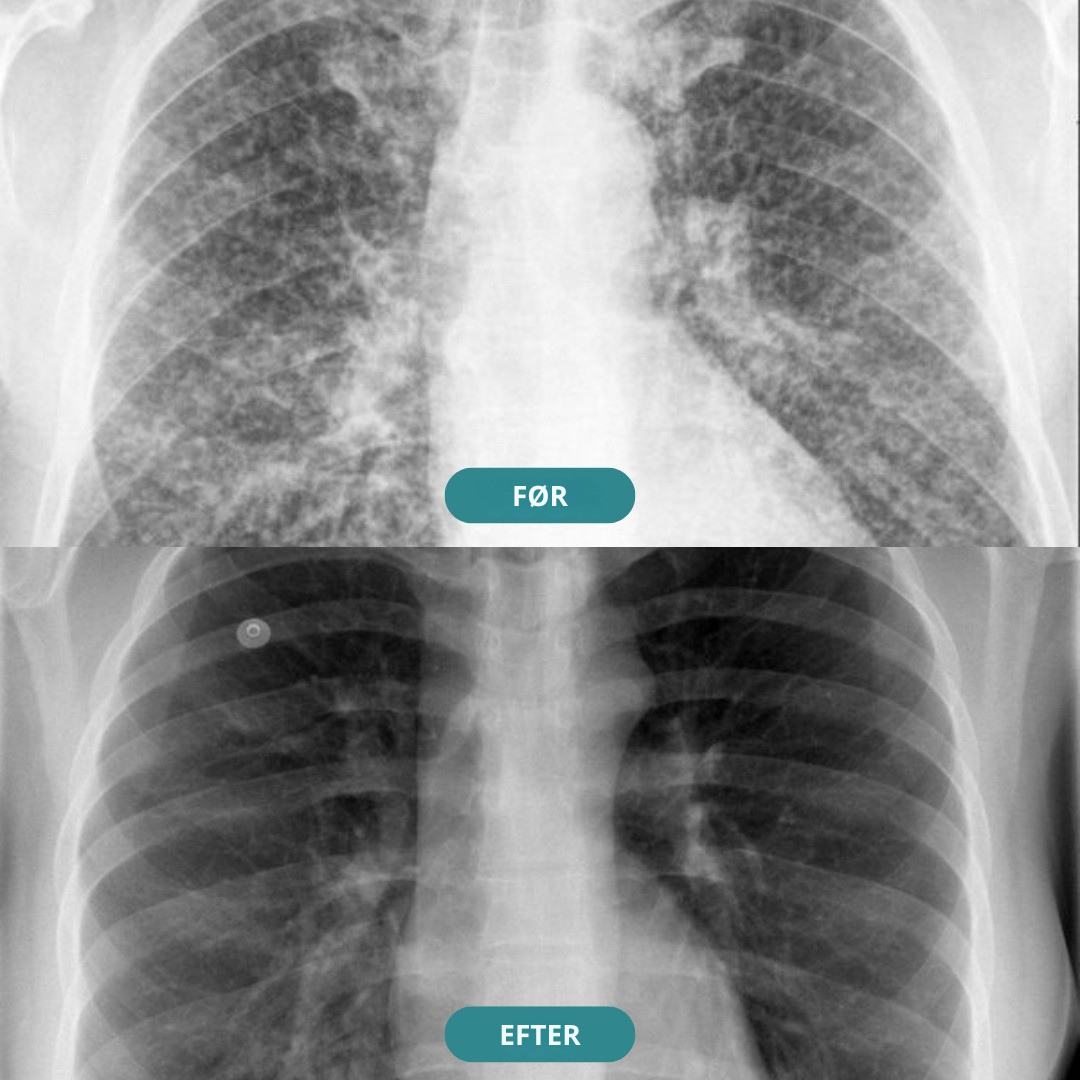 QuitStick™ - Stop med at ryge på 3 dage uden voldsom trang