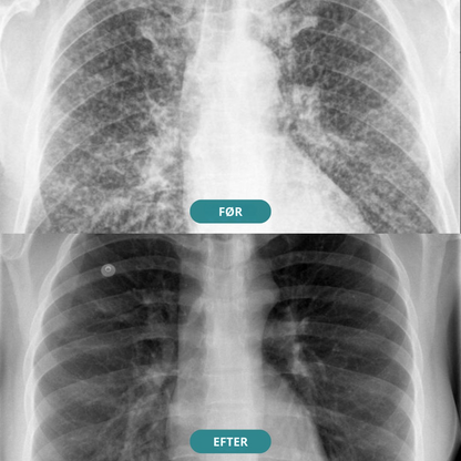 QuitStick™ - Stop med at ryge på 3 dage uden voldsom trang