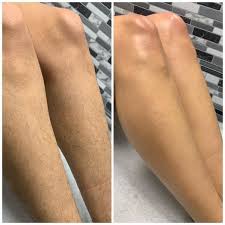 Tro ikke bare på os, se selv forskellen med BareEase™ Hårfjerningsskum hos vores kunder!